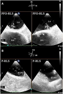 Neglected intrapulmonary arteriovenous anastomoses: A comparative study of pulmonary right-to-left shunts in patients with patent foramen ovale